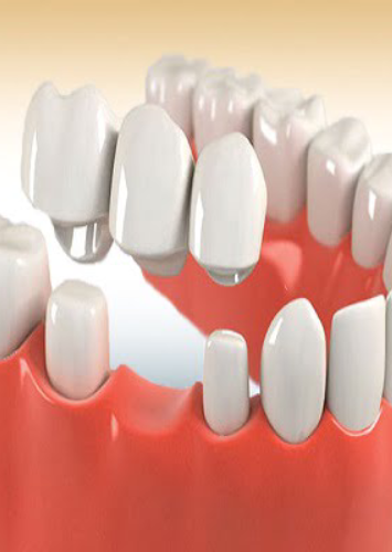 Custom dental crowns and bridges demonstration