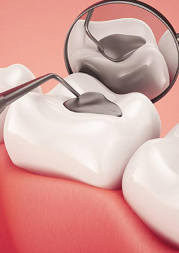 Dental filling procedure demonstrating composite material application