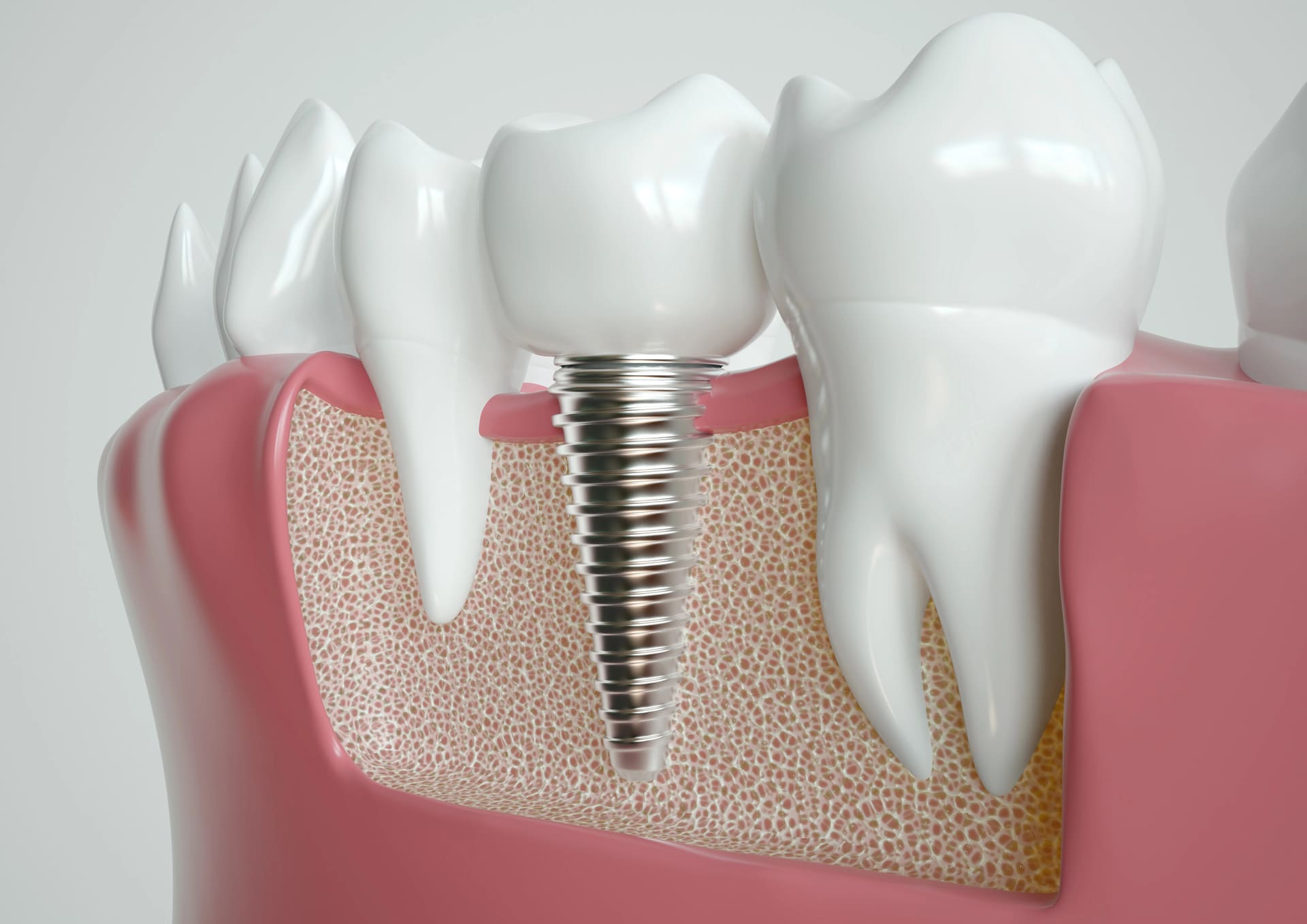 Clinical dental implant procedure or model