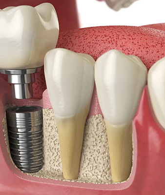 Dental Implants