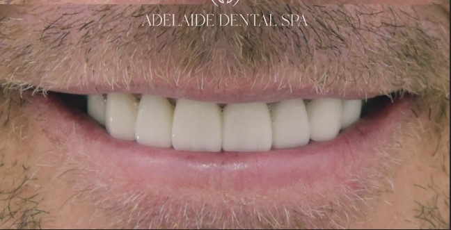 Teeth after veneers treatment