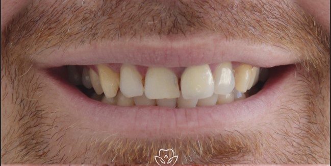 Teeth before veneers treatment