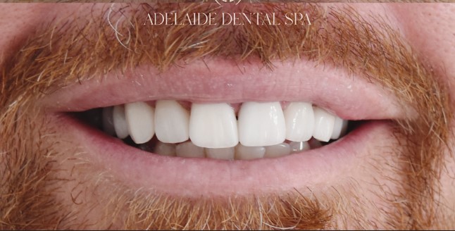 Teeth after veneers treatment