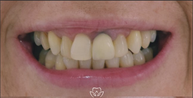 Teeth before veneers treatment
