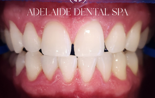 Teeth after whitening treatment