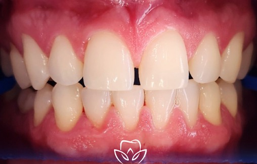 Teeth before whitening treatment