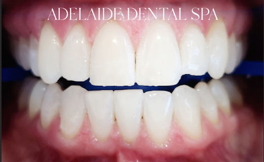 Teeth after whitening treatment