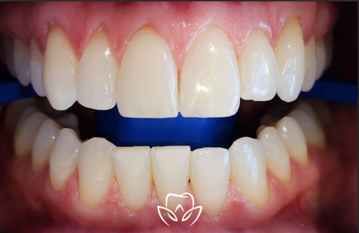 Teeth before whitening treatment