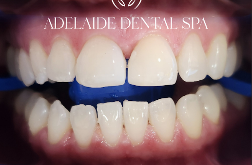 Teeth after whitening treatment