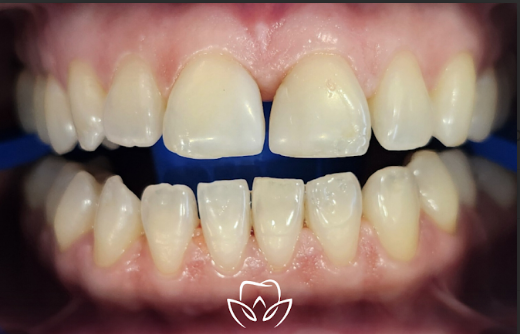 Teeth before whitening treatment