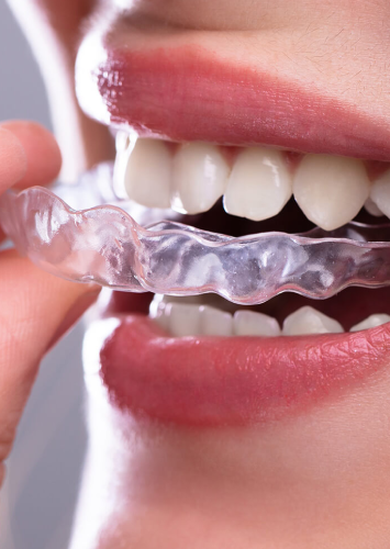 Invisalign clear aligners close-up treatment