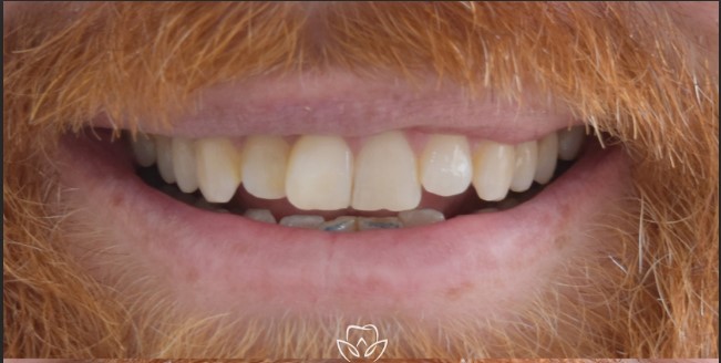 Teeth before veneers treatment