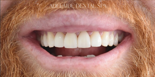 Teeth after veneers treatment