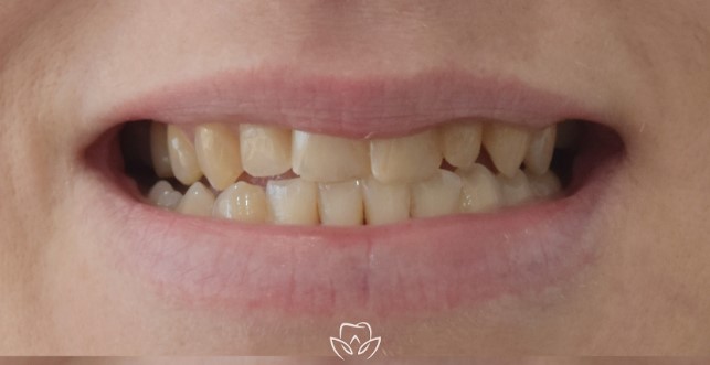 Teeth before veneers treatment