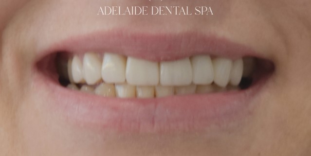Teeth after veneers treatment