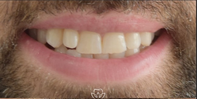 Teeth before veneers treatment