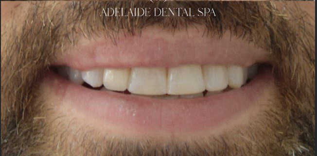 Teeth after veneers treatment