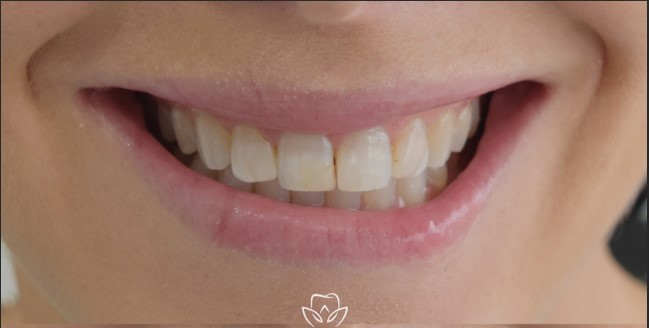 Teeth before veneers treatment