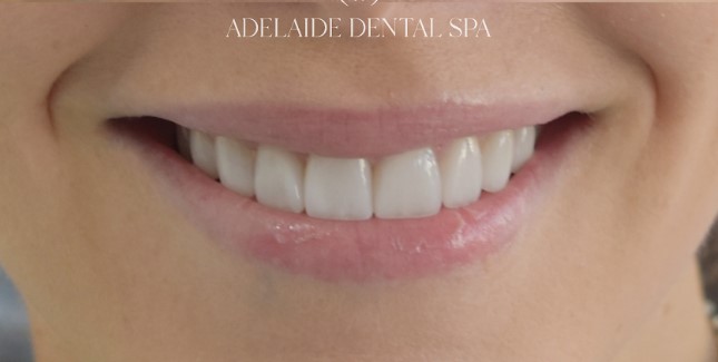 Teeth after veneers treatment