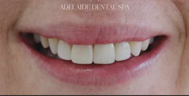 Teeth after veneers treatment