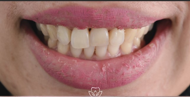 Teeth before veneers treatment