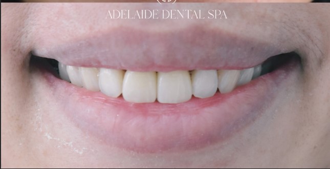 Teeth after veneers treatment